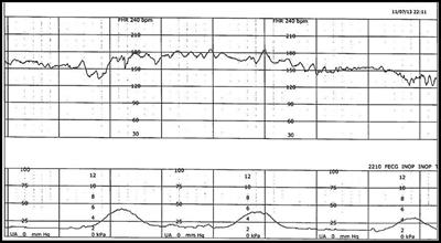 Detection of Preventable Fetal Distress During Labor From Scanned Cardiotocogram Tracings Using Deep Learning